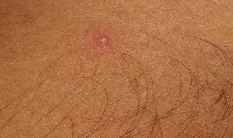What STD looks like a pimple