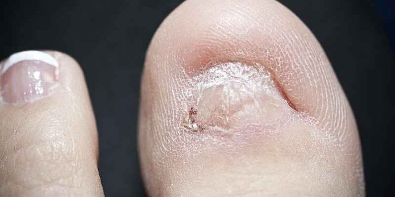 What to do after toenail falls off