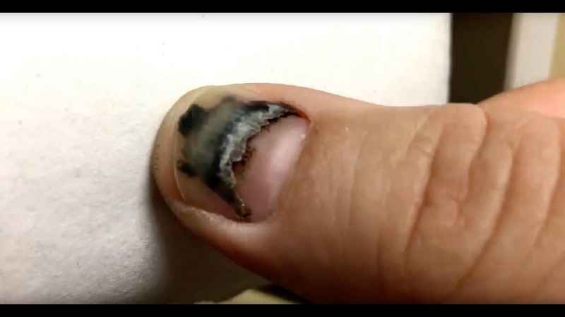 What To Do If You Lose A Finger Nail