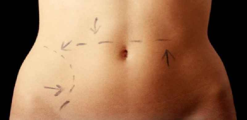 What type of anesthesia is used for tummy tuck
