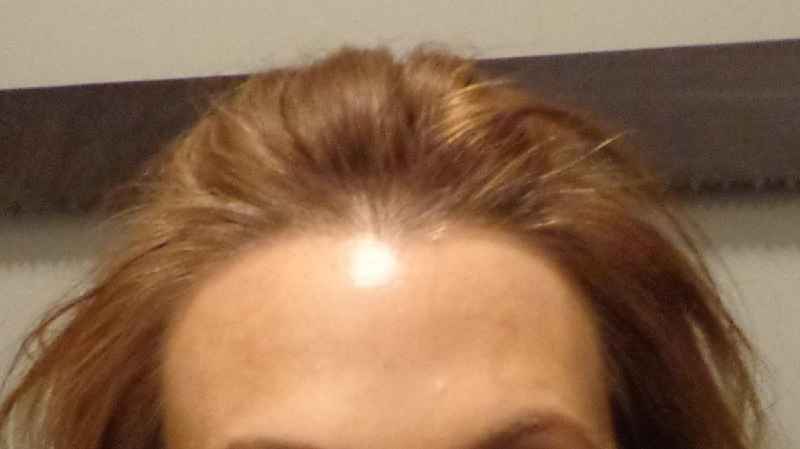 What type of vitamin deficiency causes hair loss