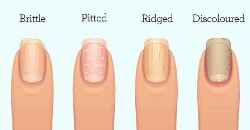 What Vitamin Are you lacking when you have ridges in your nails
