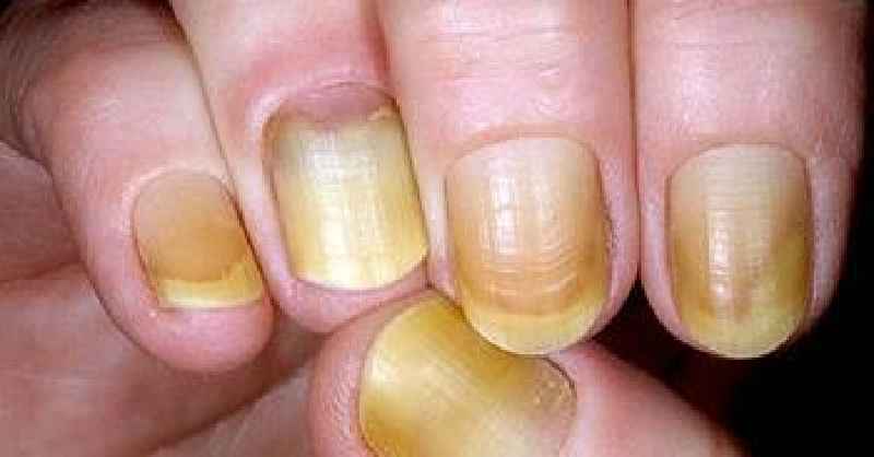 What vitamin deficiency causes dark lines in fingernails