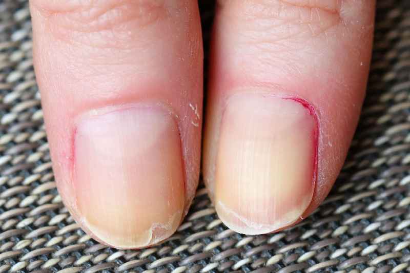 What vitamin should I take for splitting nails
