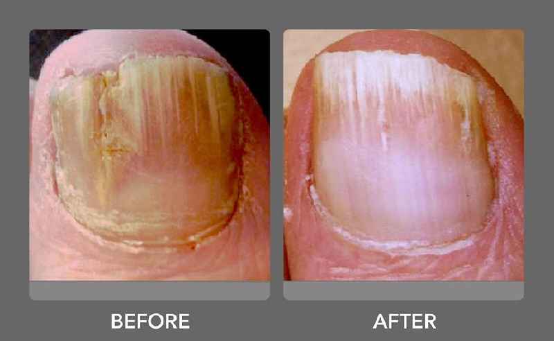 What vitamins help with nail fungus