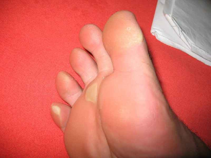 When can I walk after toenail removal