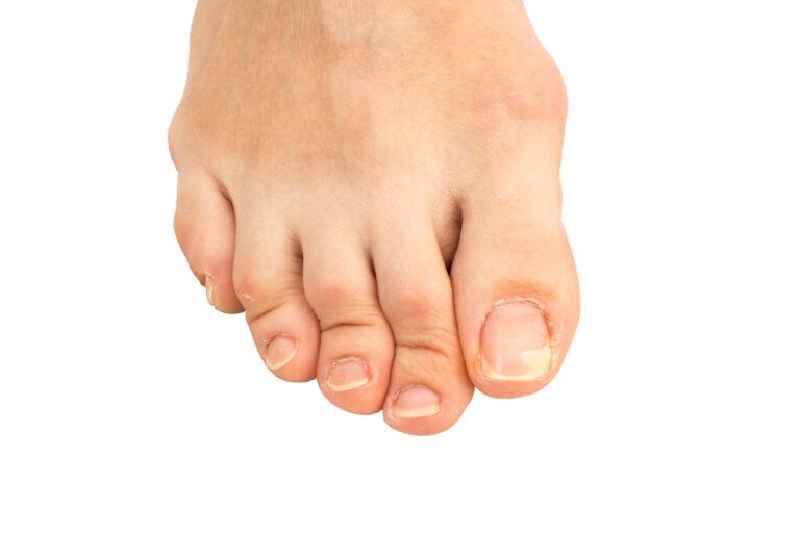 When should you seek medical attention for an ingrown toenail