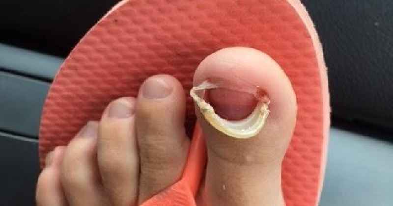 When will a podiatrist remove my toenail