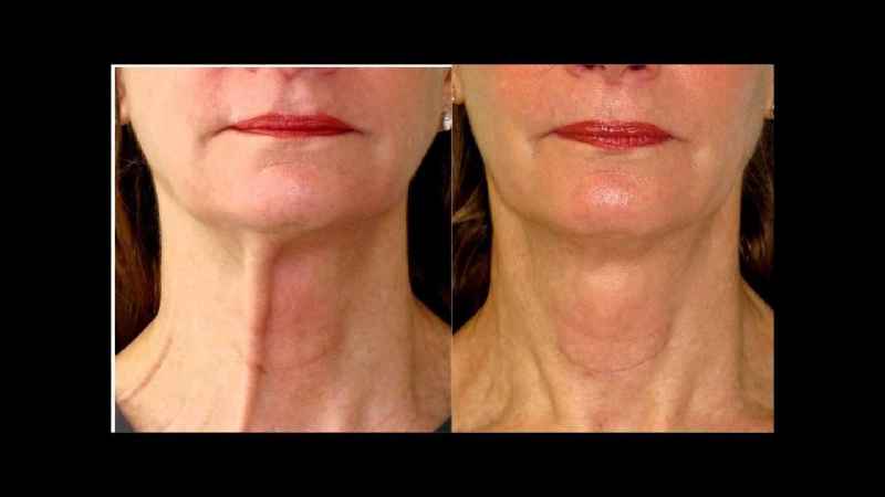 Where are the scars for a neck lift