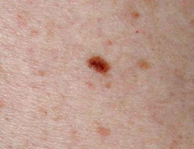 Where does nail melanoma start