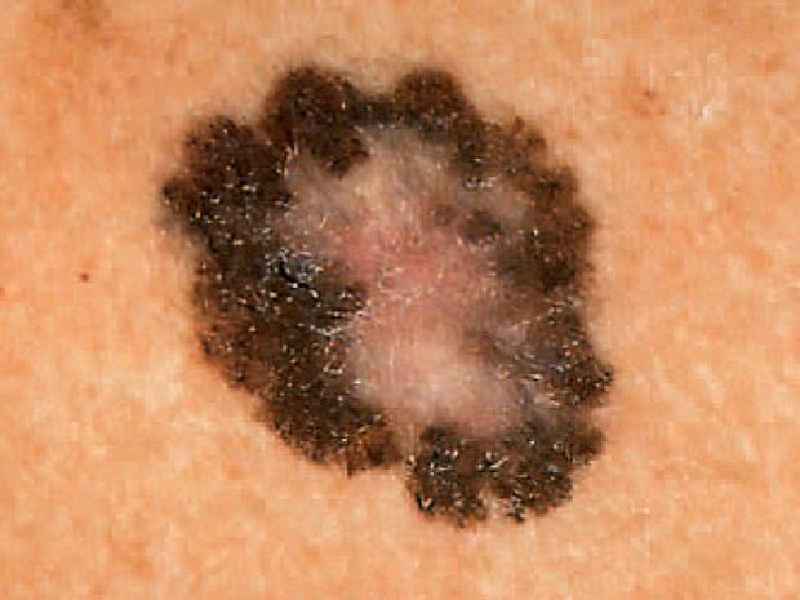 Where is the most common place to get skin cancer