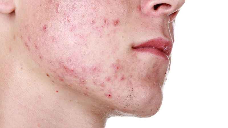 Which acid is best for acne scars
