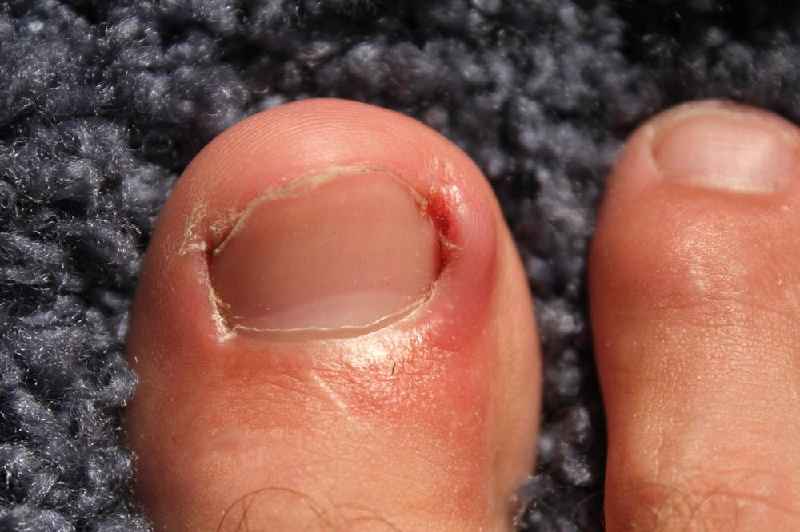 Which antibiotic is best for nail infection