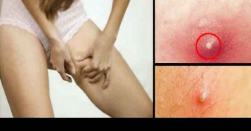 Which cellulite treatment is most effective