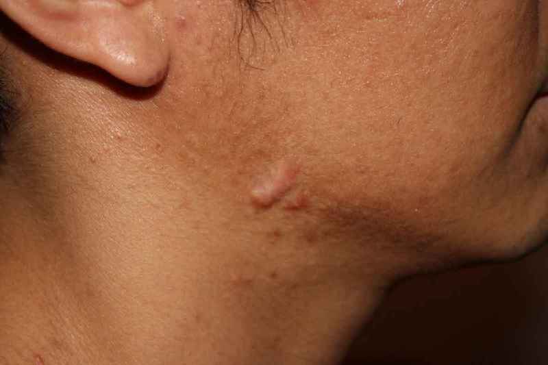 Which cream is best for pitted acne scars