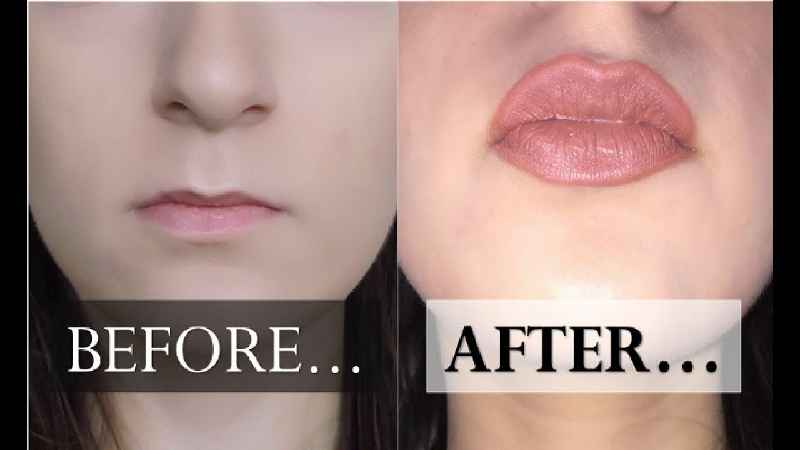 Which filler is best for thin lips