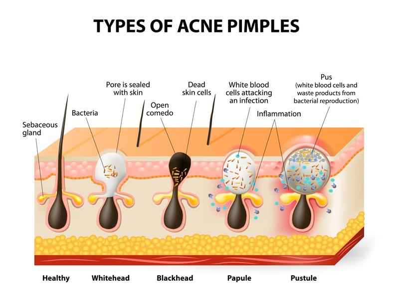 Which food causes pimples