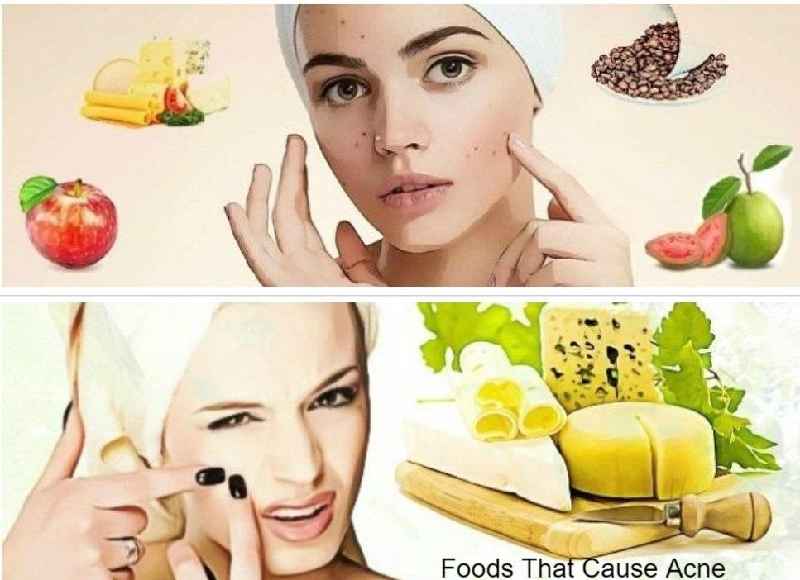 Which food causes pimples