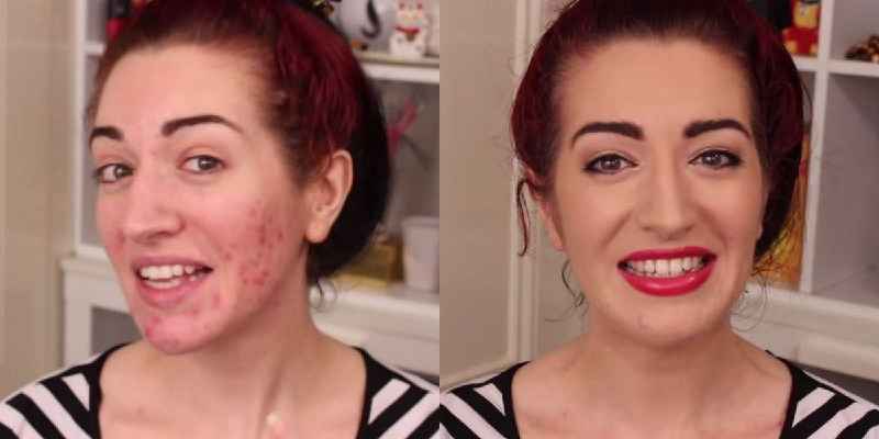 Which foundation cover acne scars the best