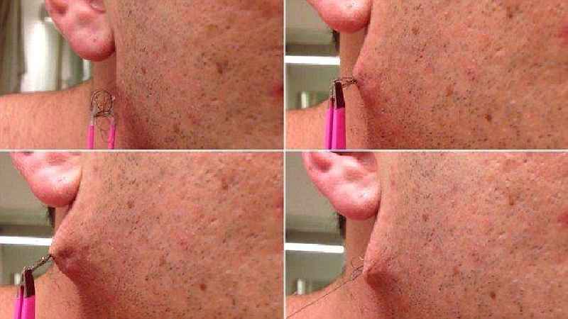 Which hair removal lasts longest