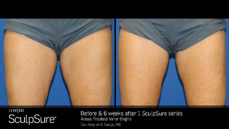 Which has better results CoolSculpting or Sculpsure