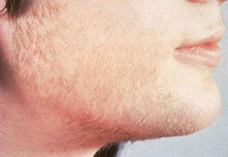 Which hormone causes facial hair growth in females