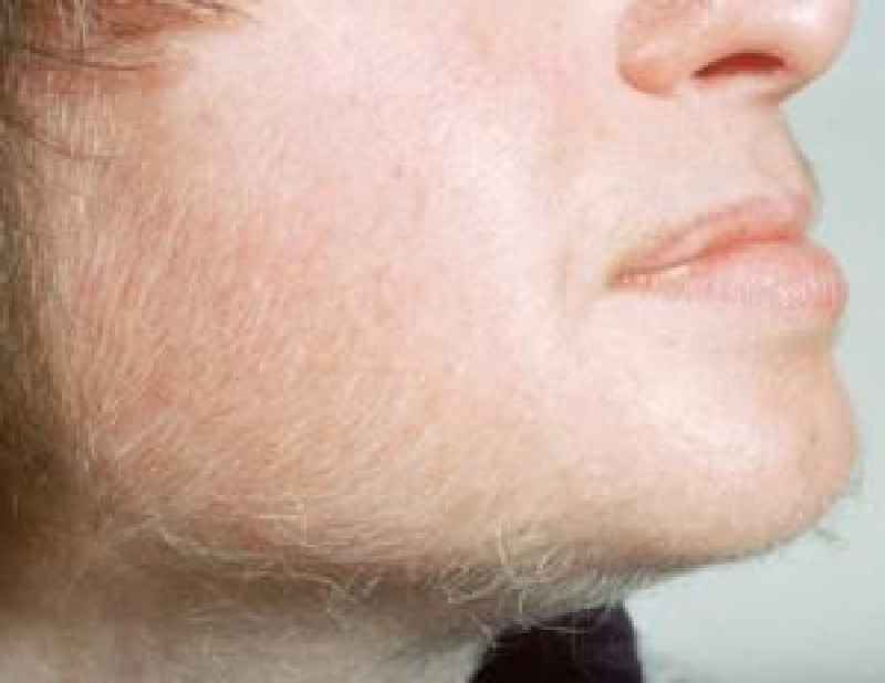 Which hormone causes facial hair growth in females