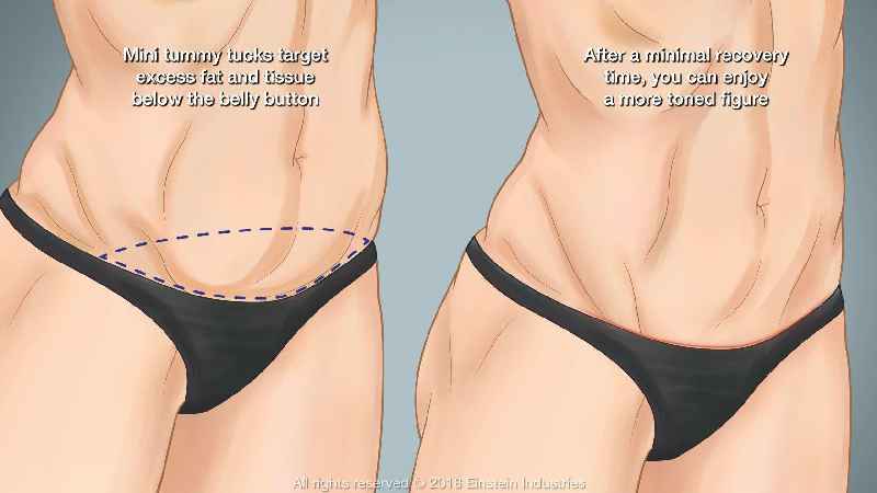 Which incision is usually employed for an abdominoplasty
