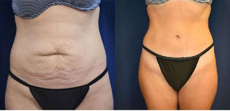 Which is better a tummy tuck or CoolSculpting