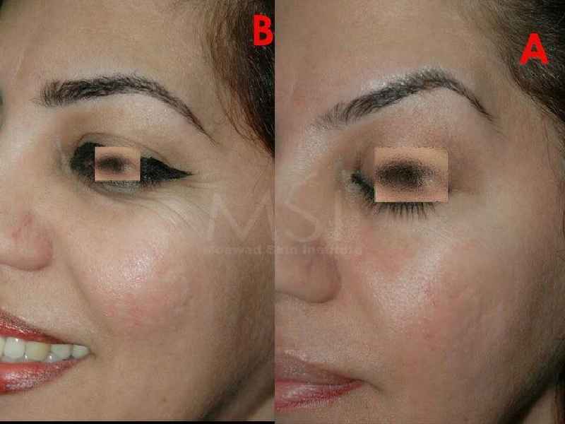 Which is better Botox or fillers