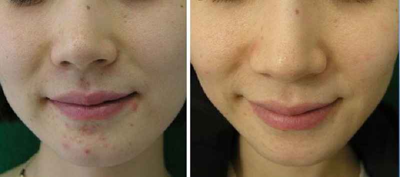 Which is better microcurrent or Microneedling