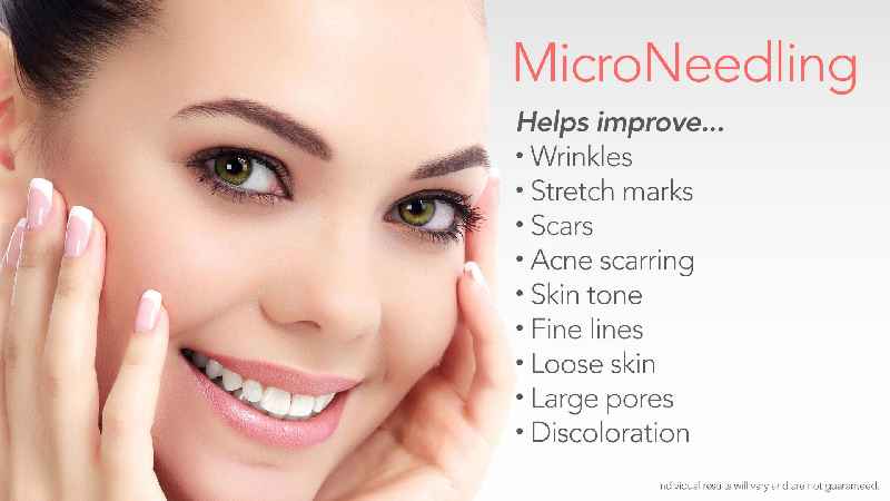 Which is better microneedling or Ultherapy
