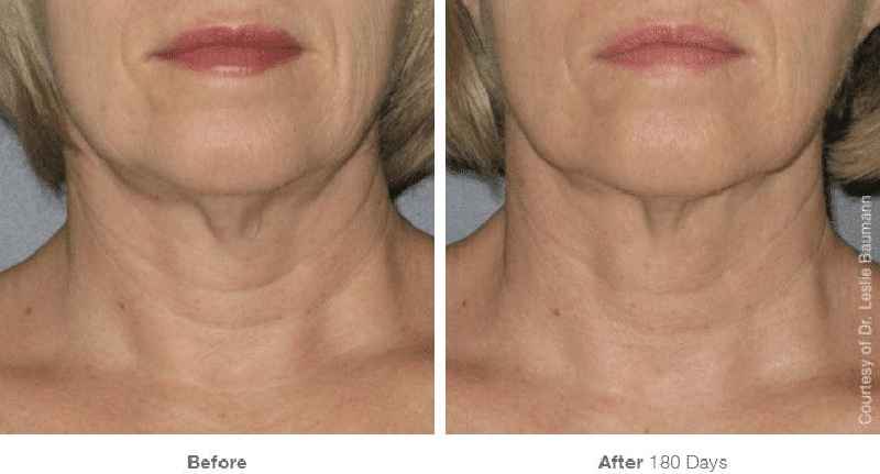 Which is better Morpheus8 or ultherapy
