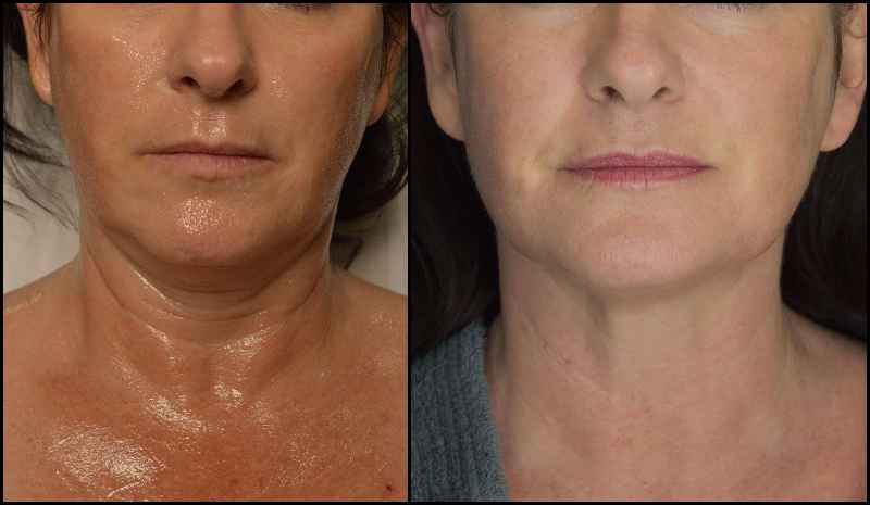 Which is better Morpheus8 or ultherapy