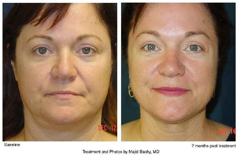 Which is better Thermage or ultherapy