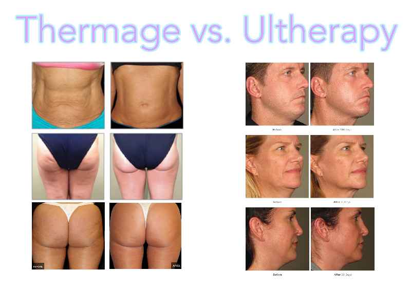 Which is better Thermage or Ultherapy