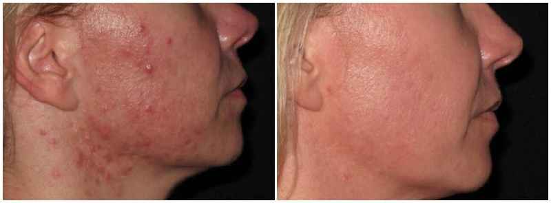 Which is better ultherapy or microneedling