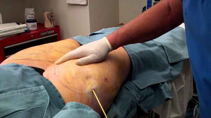 Which liposuction procedure removes the most fat