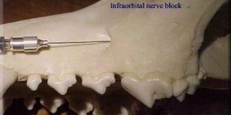 Which local anesthetic is used for nerve blocks