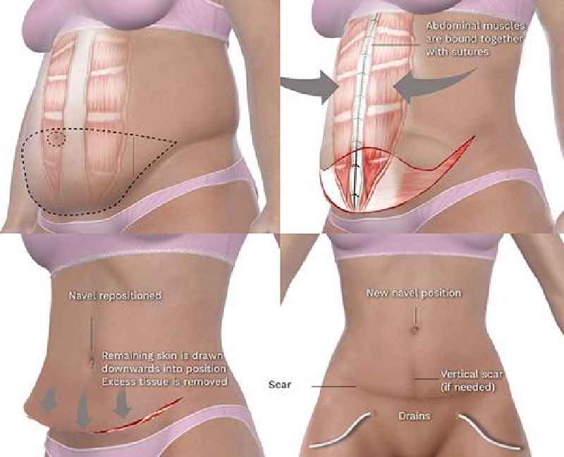 Which muscles are tightened in an abdominoplasty procedure