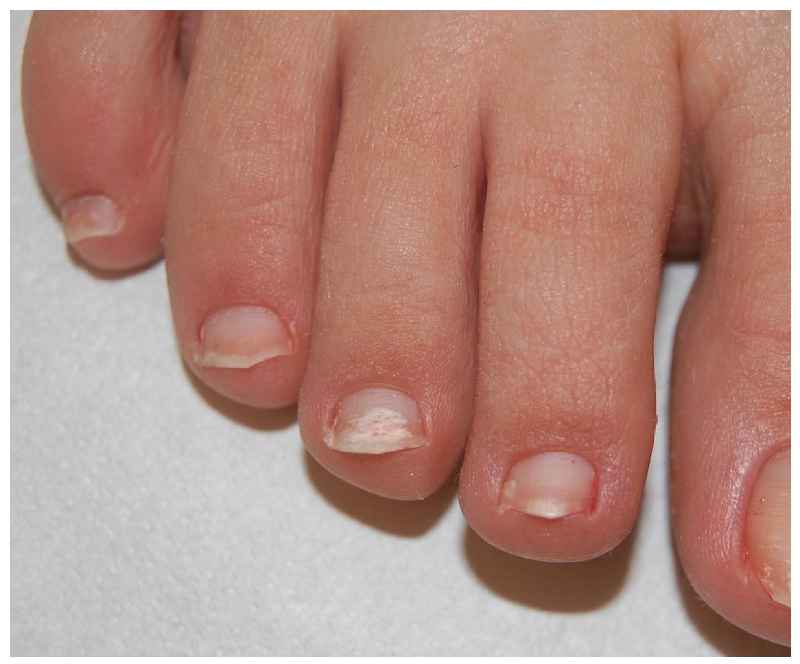 Which nail fungus treatment is best