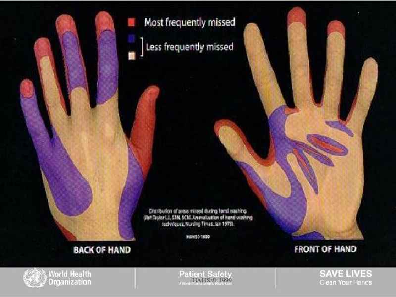 Which of the 5 moments of hand hygiene is most commonly missed