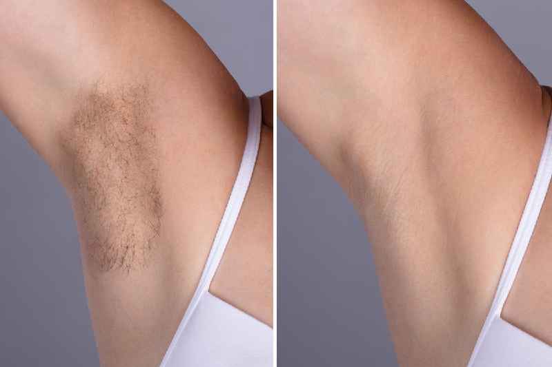 Which of the following is a method of permanent hair removal