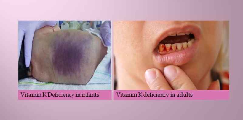Which of the following is caused by vitamin K deficiency