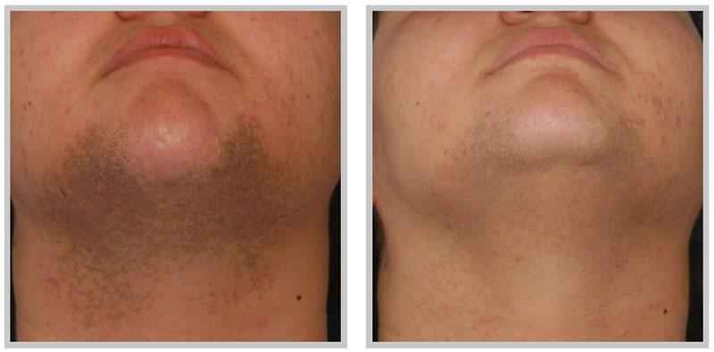 Which process is best for facial hair removal