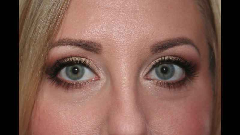 Which Restylane is best for under eyes