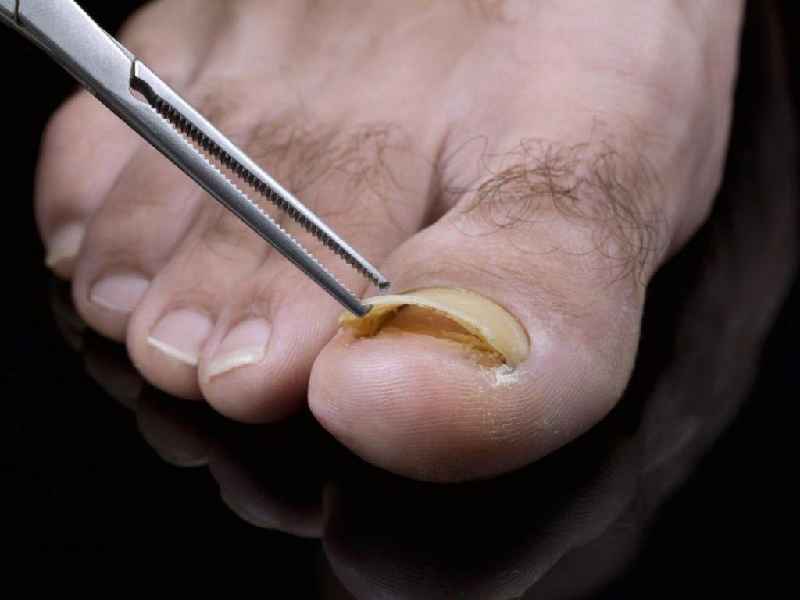 Who cut diabetic toenails