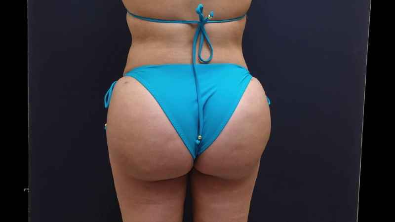 Why are Brazilian butt lifts popular