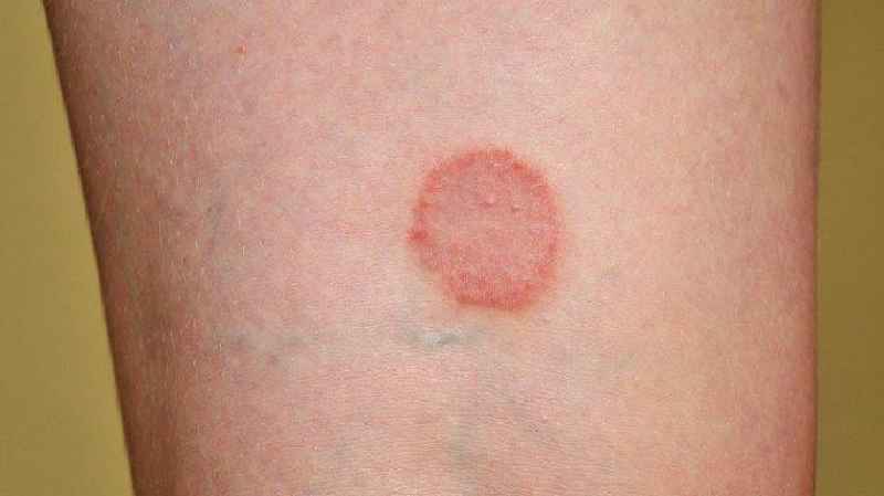 Why are diabetics prone to fungal infections