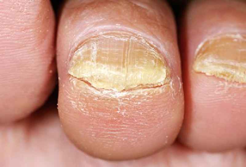 Why do elderly get thick toenails